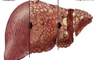 Диффузные изменения печени