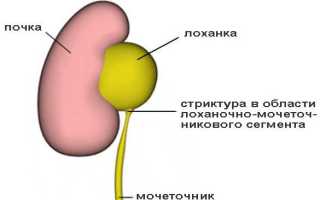 Стриктура мочеточника