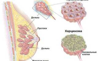 Карцинома молочной железы