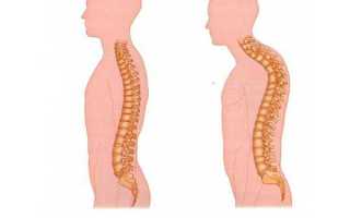 Кифоз грудного отдела позвоночника