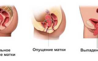 Выпадение матки