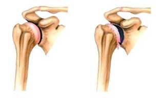 Артроз плечевого сустава