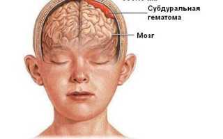 Субдуральная гематома