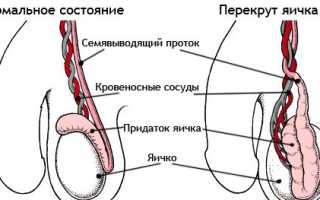 Перекрут яичка