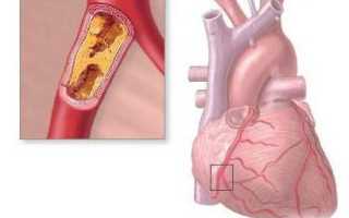 Коронарная недостаточность