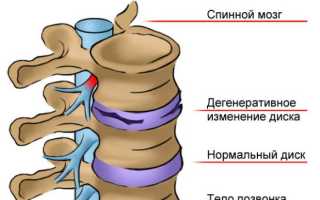 Дорсопатия