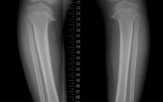 Болезнь Блаунта