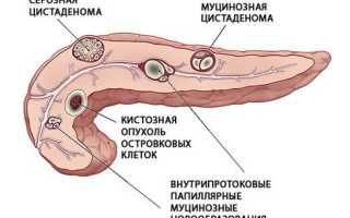 Киста поджелудочной железы