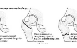 Перелом шейки бедра