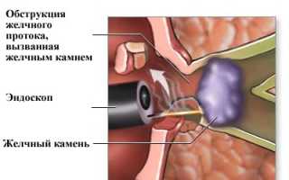 Постхолецистэктомический синдром