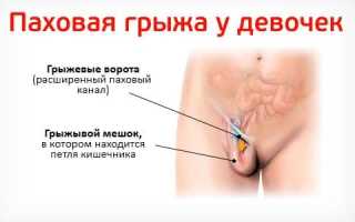 Паховая грыжа у детей