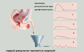 Доброкачественная гиперплазия предстательной железы