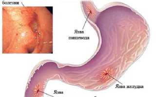 Язва двенадцатиперстной кишки