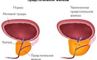 Гиперплазия предстательной железы