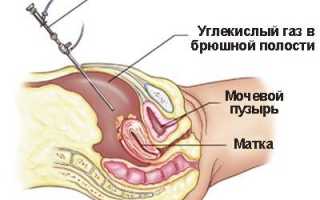 Синдром истощения яичников