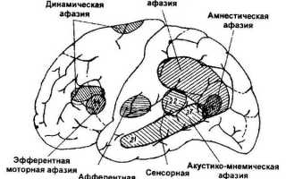 Афазия