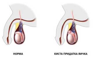 Сперматоцеле