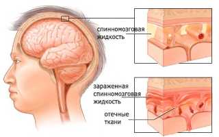 Серозный менингит