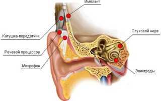 Как вернуть слух при нейросенсорной тугоухости