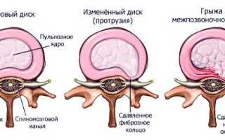 Протрузия шейного отдела позвоночника