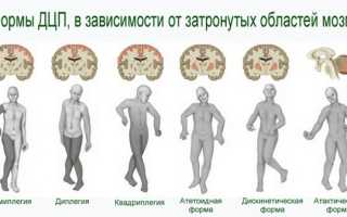 Детский церебральный паралич