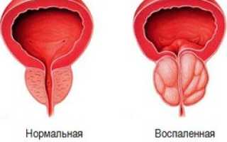 Частое мочеиспускание