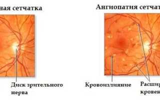 Ангиопатия сетчатки глаза