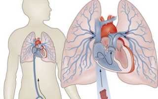Тромбоэмболия лёгочной артерии