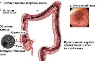 Дискинезия кишечника