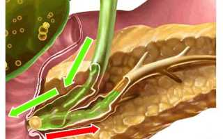 Билиарный панкреатит