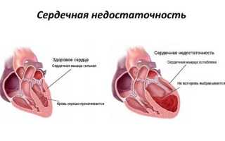 Транспозиция магистральных сосудов