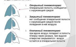 Пневмоторакс