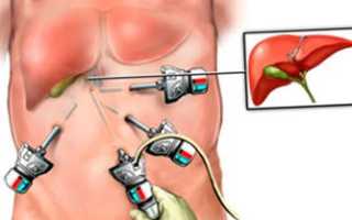 Лапароскопия