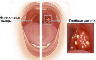 Гнойная ангина