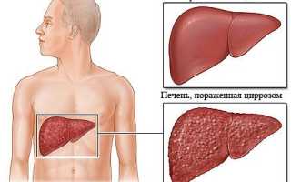 Билиарный цирроз печени