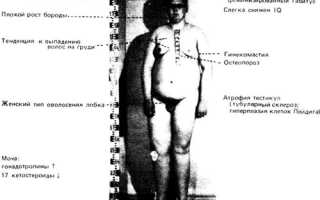 Синдром Клайнфельтера