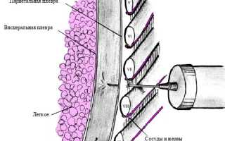 Экссудативный плеврит (гидроторакс)