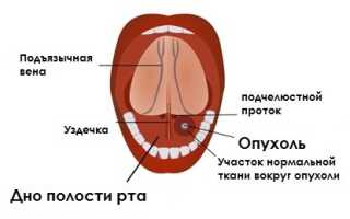 Рак ротовой полости