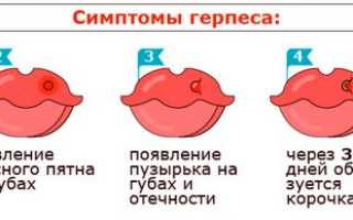 Вирус простого герпеса