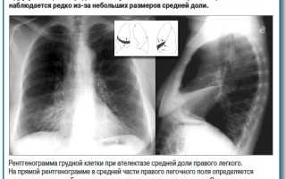 Ателектаз легкого