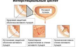 Интерстициальный цистит