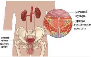 Хронический простатит