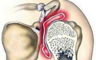 Боль в плечевом суставе
