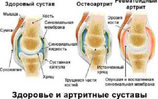 Остеоартроз