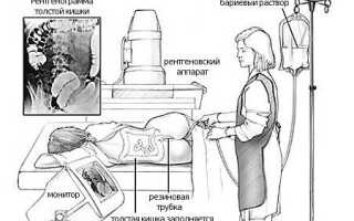 Болезнь Уиппла