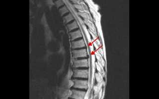 МРТ грудного отдела позвоночника