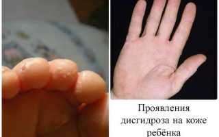 Дисгидроз