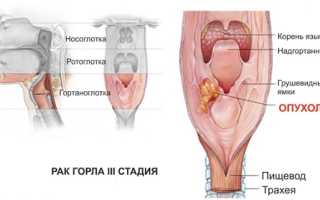 Рак горла (гортани)