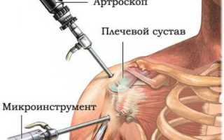 Плечелопаточный периартрит