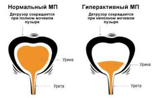 Гиперактивный мочевой пузырь